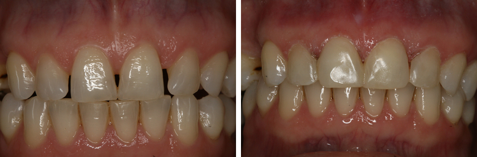 Cosmetic Bonding in Foggy Bottom - Blossom Dentistry