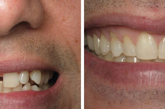 Teeth Before & After