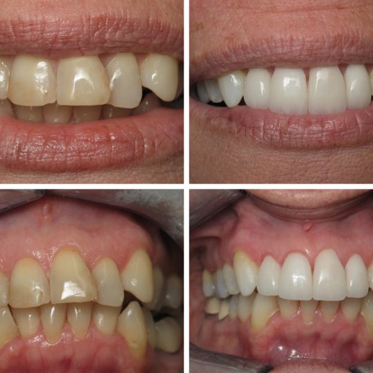 Teeth Before & After