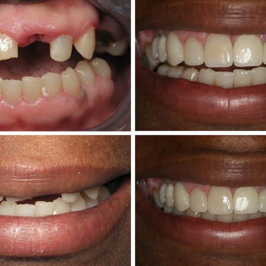 Filling teeth Before & After Picture