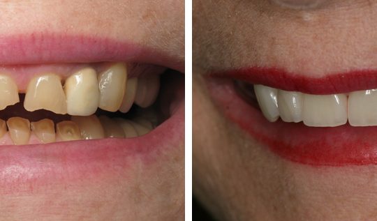 Filling teeth Before & After Picture