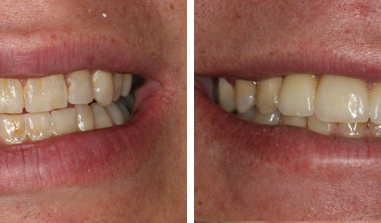 Filling teeth Before & After Picture