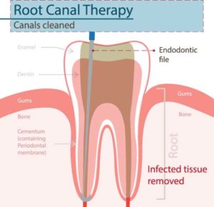 Root Canal Treatment Diagram